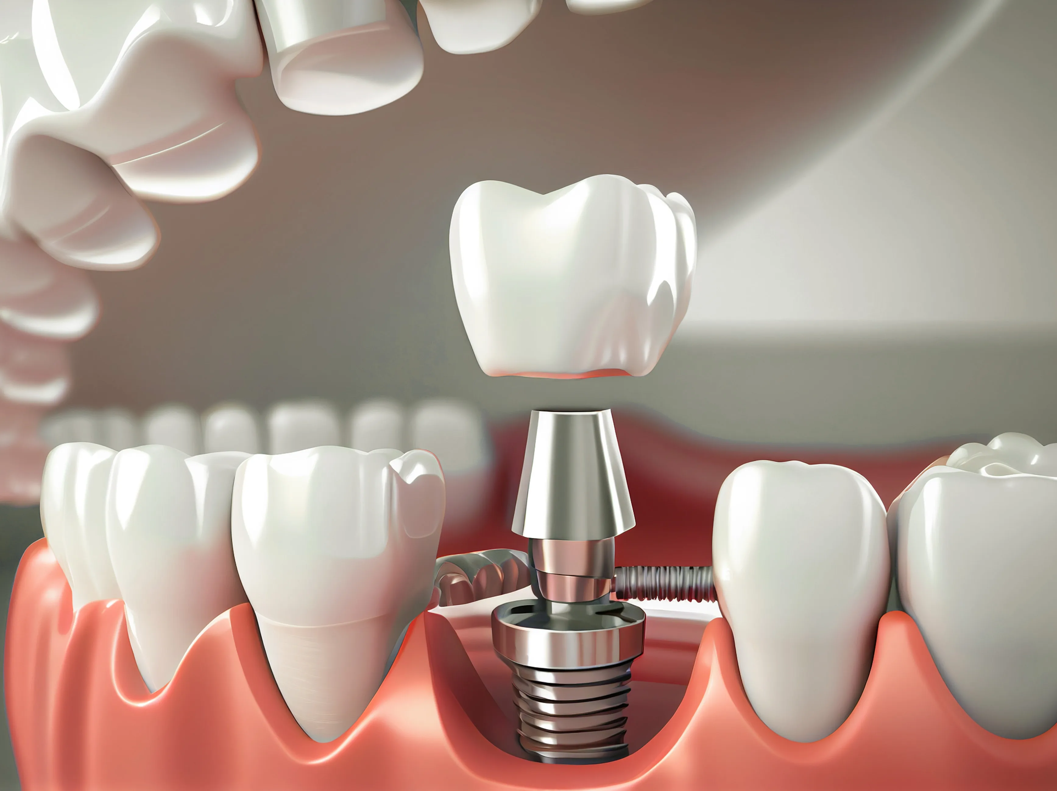 Chất lượng của implant Thụy Sỹ được xây dựng trên nền tảng khoa học và công nghệ
